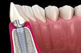 Side-view illustration of dental implant in jawbone