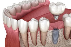 Illustration of dental implant in jawbone