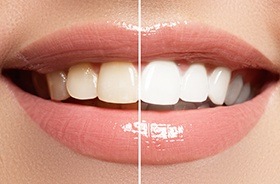 Closeup of smile half before and half after teeth whitening