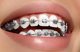 Closeup of smile with bracket and wire braces