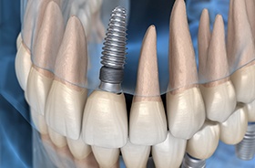 X-ray diagram showing dental implants in Buzzards Bay after placement