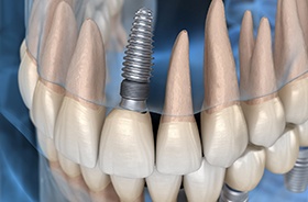 X-ray diagram showing dental implants in Buzzards Bay after placement