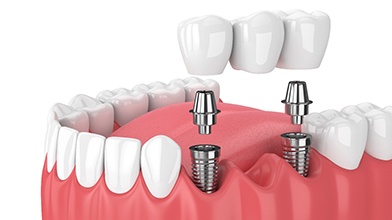 Diagram of implant bridge replacing multiple missing teeth in Buzzards Bay
