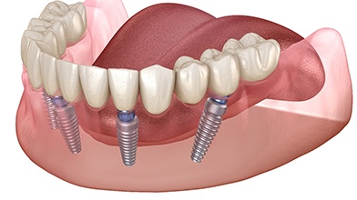 Diagram of implant denture in Buzzards Bay