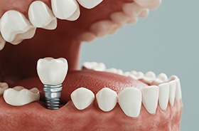 Diagram showing how dental implants in Buzzards Bay are placed