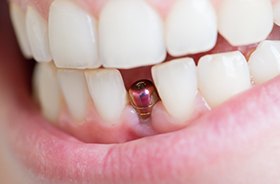 Closeup of dental implant in Buzzards Bay after placement