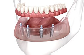 Illustration of implant dentures for lower arch