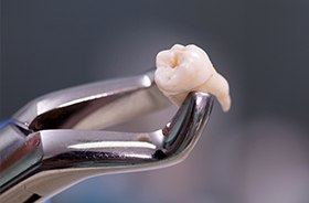 Metal clasp holding extracted tooth