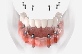 Illustration showing implant denture for lower arch