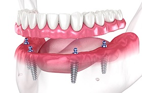 Illustration of implant denture for lower arch against white background