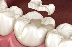 dental inlay