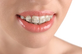 ceramic braces
