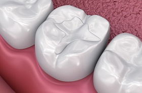 Graphic of dental sealant