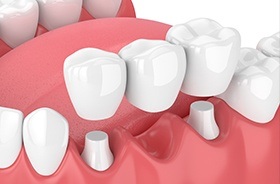 Animation of dental bridge placement