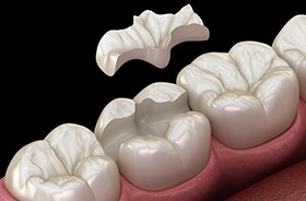 Graphic of tooth-colored filling