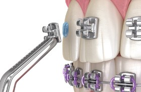 Illustration of metal braces being bonded onto teeth
